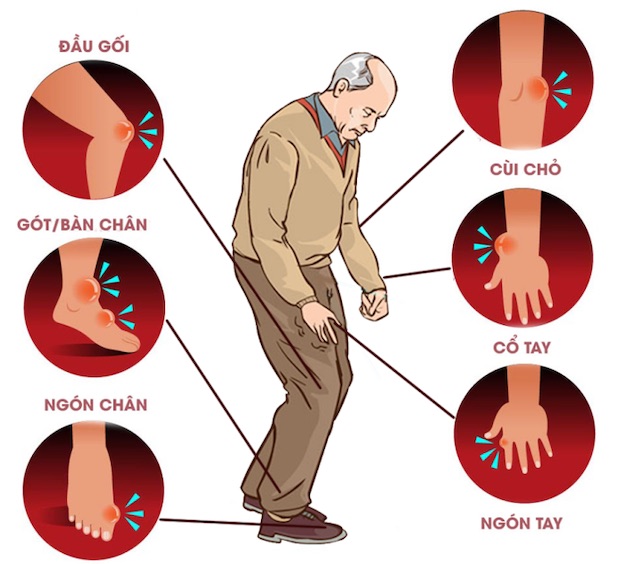 Công thức chữa bệnh gout